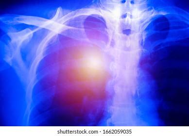 Chest X-ray Of  Patient Alveoli Damage Infected Coronavirus Or Covid-19 Concept.