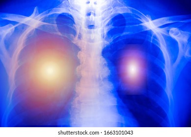 Chest X-ray Of  Patient Alveoli Damage Infected Coronavirus Or Covid-19 Concept.