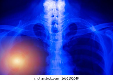 Chest X-ray Of  Patient Alveoli Damage Infected Coronavirus Or Covid-19 Concept.