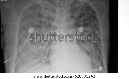  Chest Xray of the patient diagnosed as Adult Respiratory Distress Syndrome in Severe Pancreatitis 