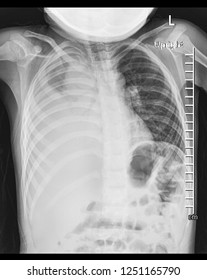 Chest X-ray Of The Patient Diagnosed As Right Lung Empyema Thoracis. (pus Accumulates In The Pleural Space)