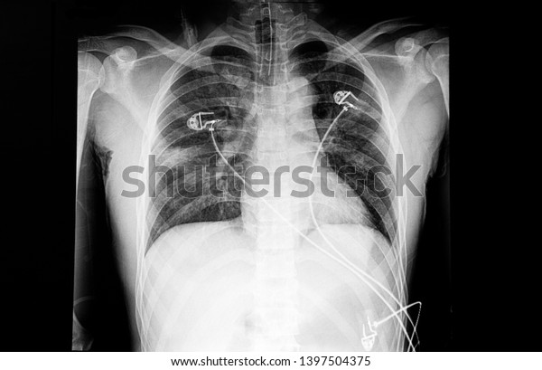 Chest Xray Patient Dyspnea Showing Bilateral Stock Photo 1397504375 ...