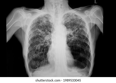Chest xray of of patient with emphysematous lungs, hilar adenopathy, and granulomatous changes of both upper lungs. - Shutterstock ID 1989533045