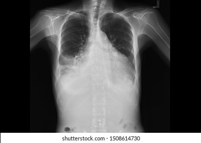 A Chest X-ray Of A Patient With Heart Failure And Pleural Effusion. The Film Shows Enlargement Of The Heart Or Cardiomegaly. The Patient Has Dyspnea And Chest Pain. 