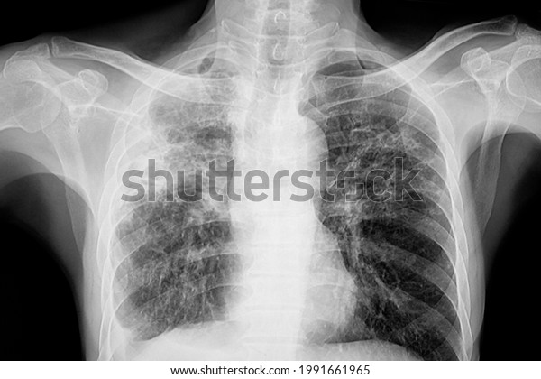 Chest Xray Patient Lungs Tuberculosis Showing Stock Photo (Edit Now ...