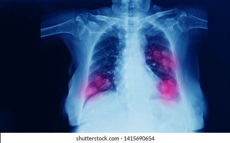 Chest x-ray of a patient showing primary lung cancer in both right and left lobe of lung. Dark background with red highlight focus on the tumor.