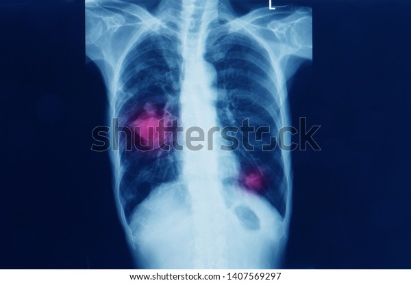 Chest Xray Patient Showing Primary Lung Stock Photo (Edit Now) 1407569297