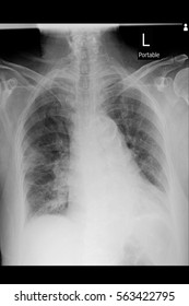 Chest Xray Portable Image Show Pneumonia Stock Photo 563422795 ...