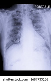 Chest Xray Portable Show Acute Respiratory Distress Syndrome And Coronavirus