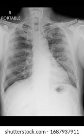 Chest Xray Portable Show Acute Respiratory Distress Syndrome And Coronavirus