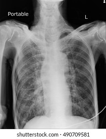 Chest Xray Portable Show Case Tuberculosis Stock Photo 490709581 ...