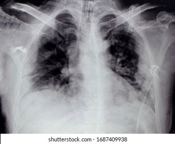 Chest Xray Vascular Access Permacath Insertion Stock Photo 1593331306 ...