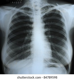 A Chest Xray Scan For A Medical Diagnosis.