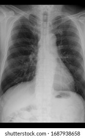 Chest Xray Show Acute Respiratory Distress Syndrome And Coronavirus