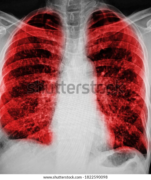 Chest Xray Show Alveolar Infiltration Both Stock Photo 1822590098 