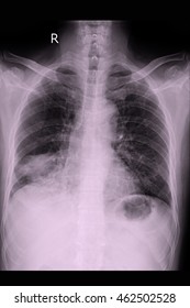 Chest Xray Show Ca Lung Stock Photo 462502528 | Shutterstock