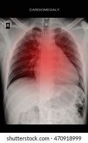 Chest Xray Show Cardiomegaly 