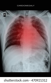 Chest Xray Show Cardiomegaly