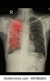 Male Chest Xray On Black Background Stock Photo (Edit Now) 121977421