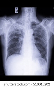 Chest Xray Show Infiltration Right Upper Stock Photo Shutterstock