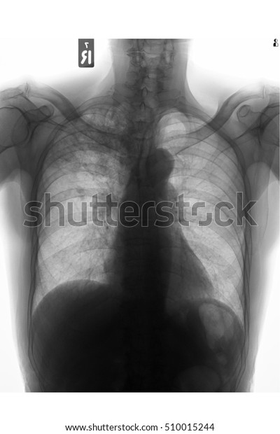 Chest Xray Show Infiltration Right Upper Stock Photo Edit Now