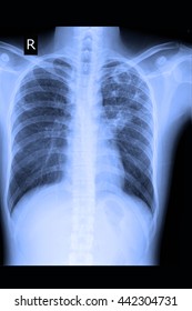 Chest Xray : Show Lung Cancer : CA Lung 