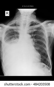 Chest Xray Show Lung Cancer And Infiltration Right Lung