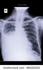 Chest Xray Show Lung Cancer Infiltration Stock Photo 484203520 ...