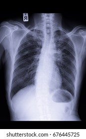 Chest Xray  Show Lung Cancer