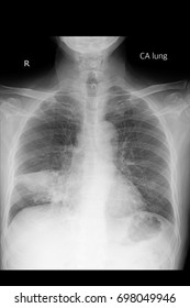 Chest Xray Show Lung Cancer