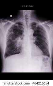 Chest Xray Show Lung Metastasis Lung Stock Photo (Edit Now) 484216654