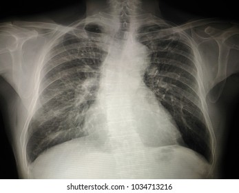 Chest X Ray Thoracic Image Showing Stock Photo (Edit Now) 1568339251