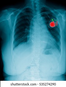 Chest x-ray show pacemaker cell 
