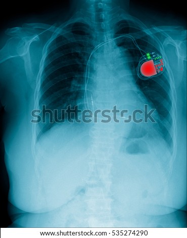Chest x-ray show pacemaker cell 