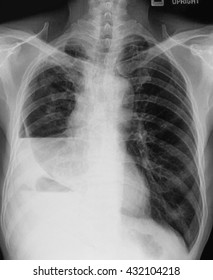 Chest Xray Show Pleural Effusion Stock Photo 432104218 | Shutterstock