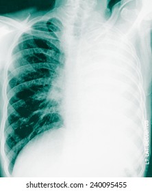 Chest Xray Show Pulmonary Disease Stock Photo 240095455 | Shutterstock