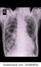 Chest Xray Show Tuberculosis Stock Photo 421843924 | Shutterstock