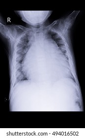 Chest Xray Show Young Child Have Cardiomegaly