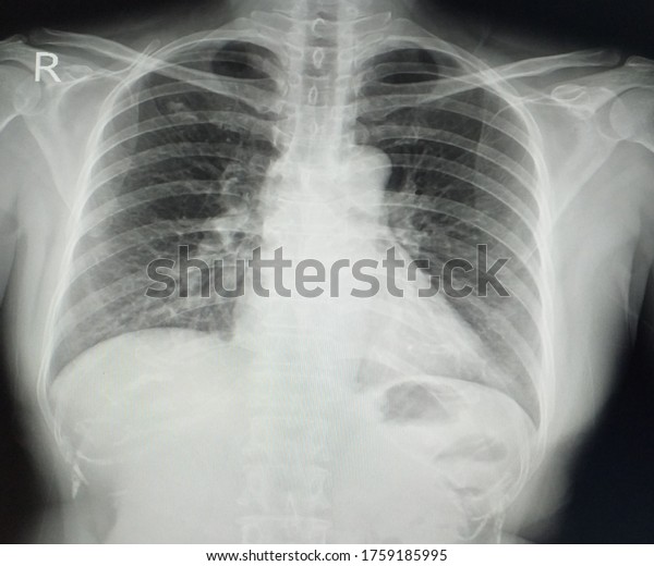 Chest Xray Showing A18cmdiameter Fibrocalcific Scar Stock Photo ...