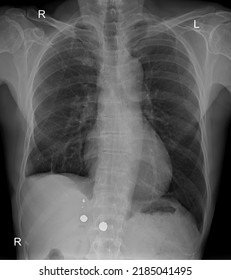 Chest X-Ray Showing The Foreign Body 