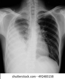 Chest Xray Showing Large Infiltrate Lingular Stock Photo 492485158 ...