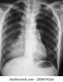 Chest Xray Showing Left Lung Pneumothorax Stock Photo 1309674166 ...