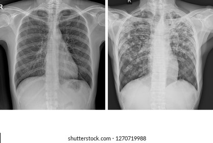 Chest Xray Showing Normal Chest Human Stock Photo 1270719988 | Shutterstock