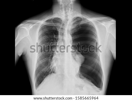 Chest x-ray showing tension pneumothorax on the left side of lung. The pathology cause pressure effect and midline shift of the heart and trachea. The patient needs emergent chest tube drainage.