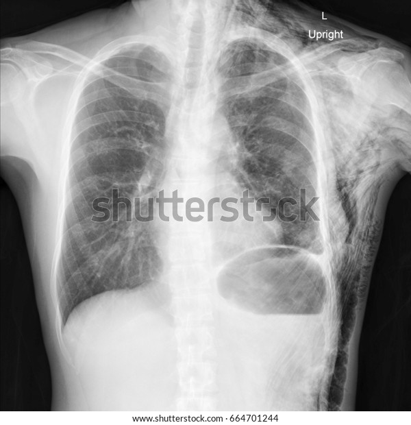 Chest Xray Shows Subcutaneous Emphysema Air Stock Photo (Edit Now ...