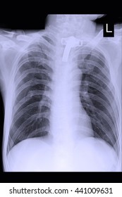 Chest Xray : Tracheostomy Tube : Lung