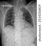 Chest X-Rays: Key Insights into the Health of the Thoracic Cavity