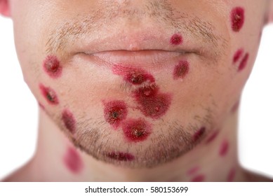 Chicken Pox On The Face Of A Man, Isolated Background