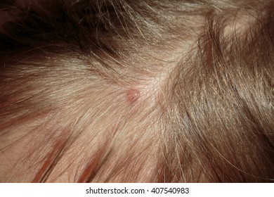 Chicken pox on scalp - Shutterstock ID 407540983