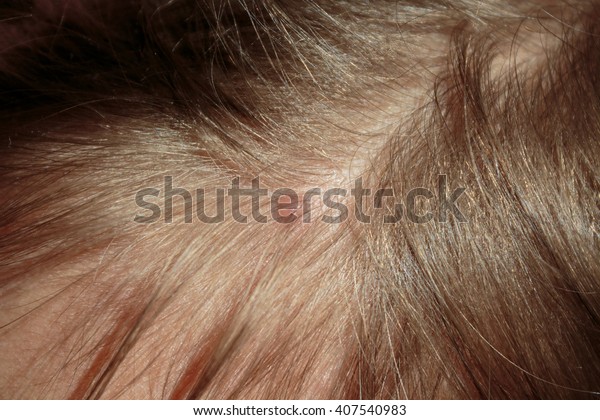 Chicken Pox On Scalp Stock Photo Edit Now 407540983